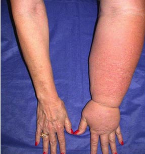 linfedema copy